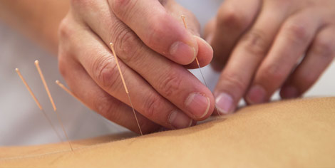 Acupuncture